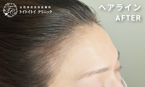 アートメイク ヘアライン 4