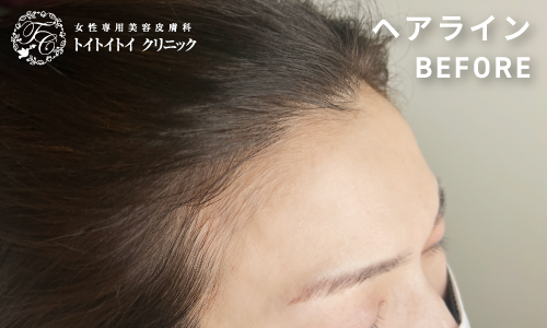 アートメイク ヘアライン 4