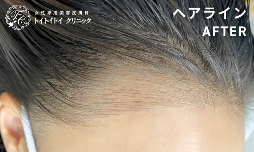 アートメイク ヘアライン 7