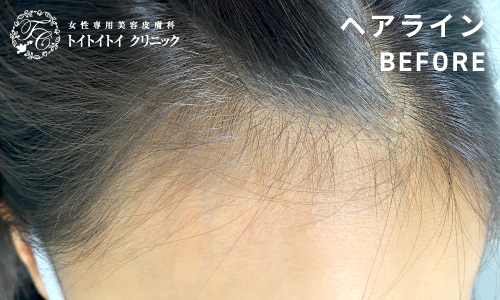 アートメイク ヘアライン 7