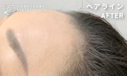 アートメイク ヘアライン 9