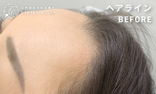 アートメイク ヘアライン 9