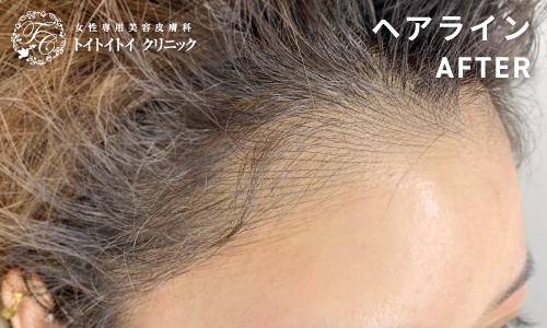 アートメイク ヘアライン 10