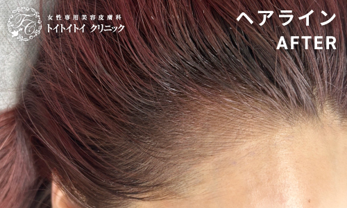 アートメイク ヘアライン 11